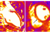 Athletes Have Telltale CMR Markers of Damage Post-COVID-19, but Clinical Significance Unclear